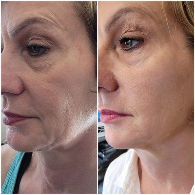 Fibroblast Plasma treatment on jowl and lower eyes