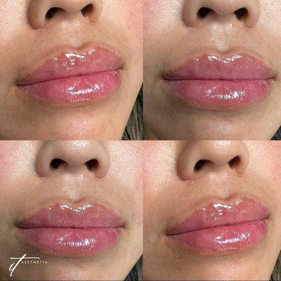 Elevate your beauty with the subtle allure of lip injections!

Our skilled experts enhance your natural features, ensuring a ...