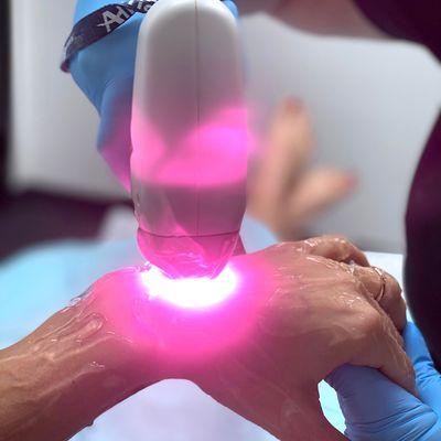 Laser Hair Removal