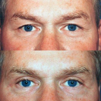 Upper blepharoplasty, amazing what a difference it can make!