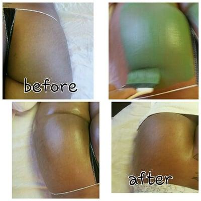 These are results from The Glowing Glutes Treatment.