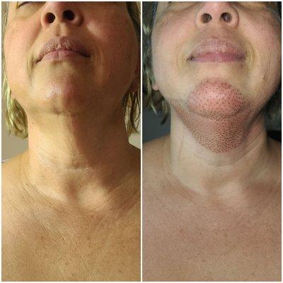 Plasma Skin Lift