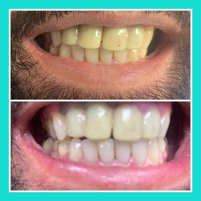 Real results. No filters. Happy clients. #teethwhitening