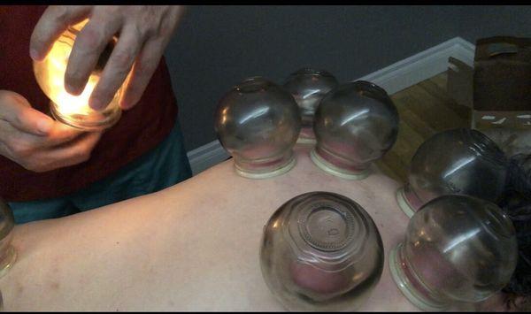 Chineese Cupping