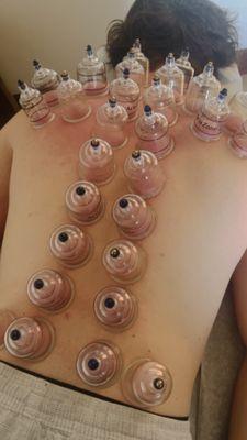 Cupping therapy