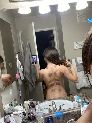 Cupping next day (i bruise terribly always lol!!)