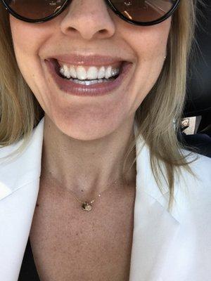 Two more weeks and these suckers are off! Thank you ladies (and Dr. Yar!) for an amazing experience! Patti, you rock!