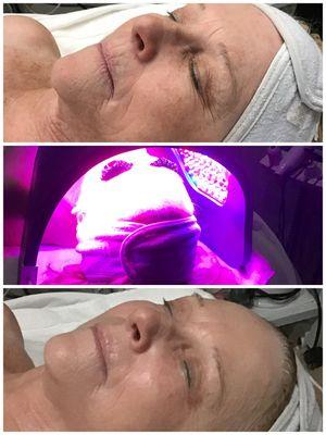 60 mins Custom Facial plus 30 LED. Glowing Skin