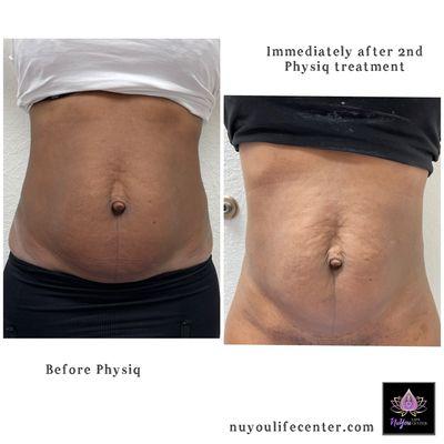 Physiq Body Contouring Laser