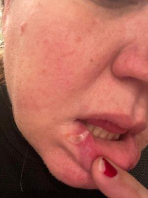 The picture is just 2 days after they burned her lip with the water attachment.