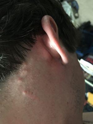 Men's Haircut infection