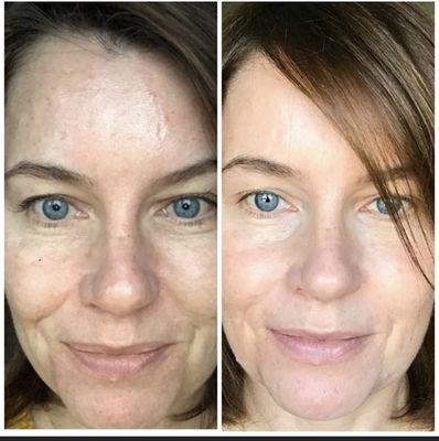 Try SkinVive! It works!