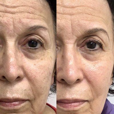 3 Sessions of Facial Infusions