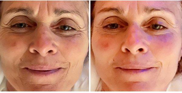 Before and After Energetic Face Lift After third session