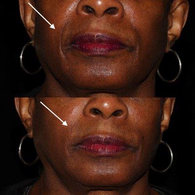 Beautiful enhancement with fillers.