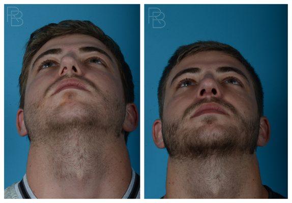 Before & After Septoplasty