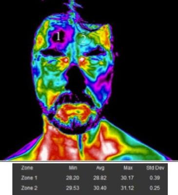 Thermographic Scan of the head showing blockage above eye. He died of a stroke 30 days post scan