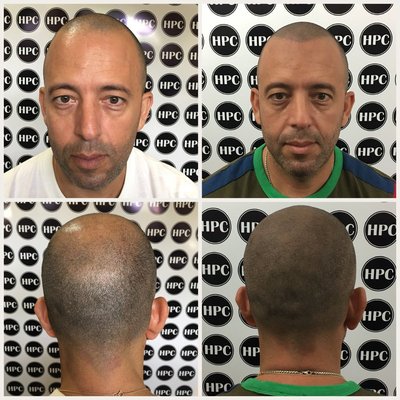 Hair Scalp Pigmentation Center