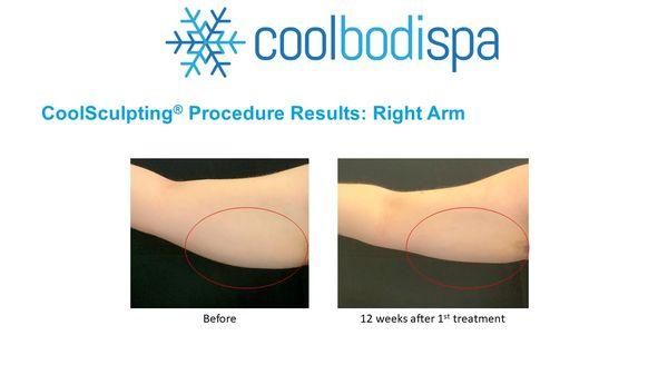 Female client 12 weeks after one Coolsculpting® treatment to her arms.