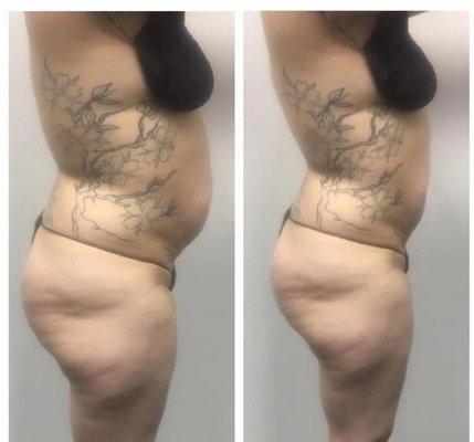 Laser Lipo Treatment! Wait to shed and rid belly fat! Contact Meek today!