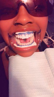 Teeth whitening