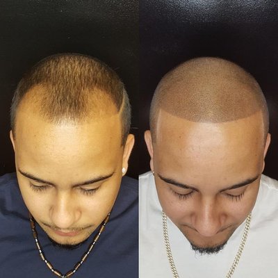 Scalp Micropigmentation Treatment,  advanced technique for hair loss