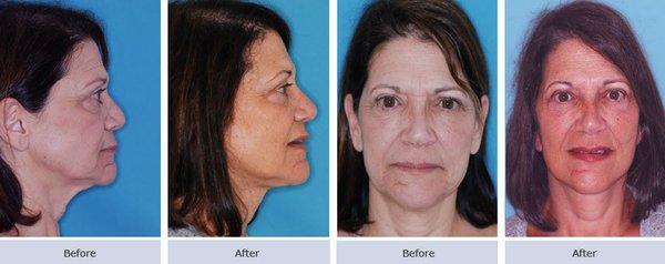 Facelift Surgery Before & After