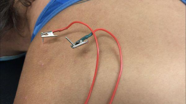 Dry Needling for Shoulder Pain