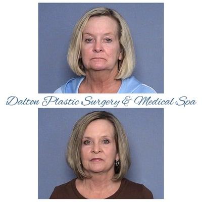 Face Lift Procedure Dalton, GA