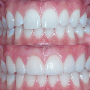 e.max Veneers