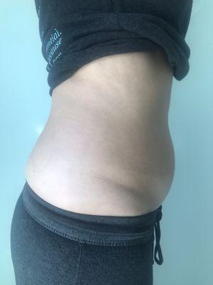 Before SculpSure warm sculpting procedure