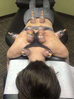 Cupping practices provide additional healing and detoxification benefits when added to chiropractic and acupuncture therapies.