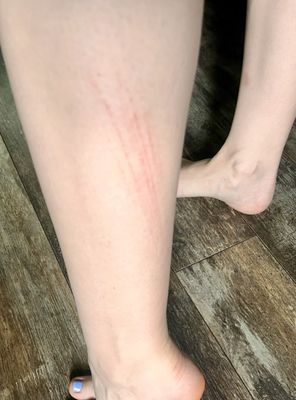 Scrapes on both legs