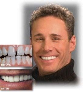 Get the smile you always wanted with our state of the art bonding procedures.