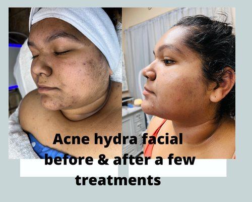 Hydrodermabrasion and Facial for acne