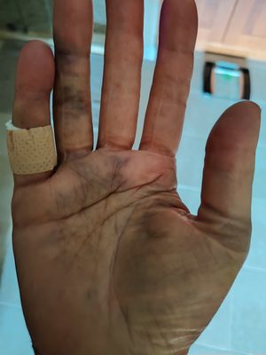 Bruising of hand (not dirt)