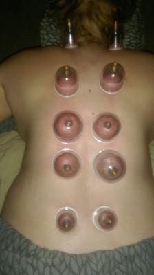 Cupping!!