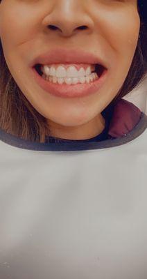 After w temp veneers waiting on permanents