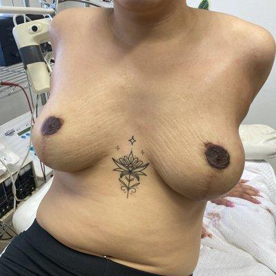 Permanent areolas, permanent nipples, nipple Pigmentation