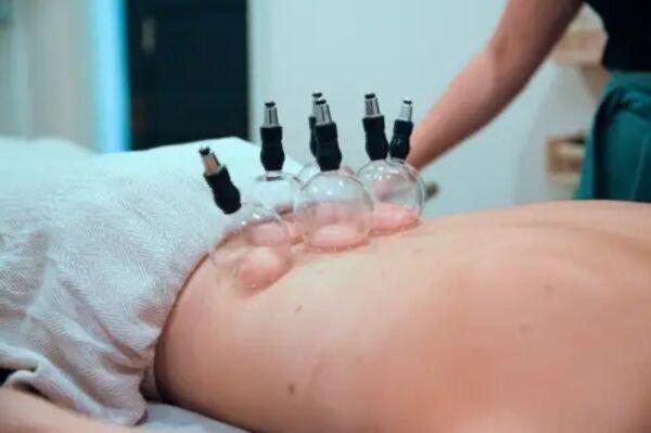 Cupping