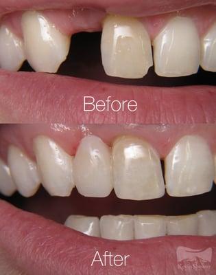 This patient lost a tooth in an accident, so we decided to do a one-appointment composite bridge due to finances, and this is the result.