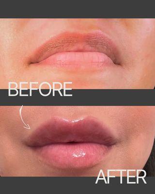 Natural lip enhancement using Revanesse Versa! After photo was taken 5 days post lip filler.