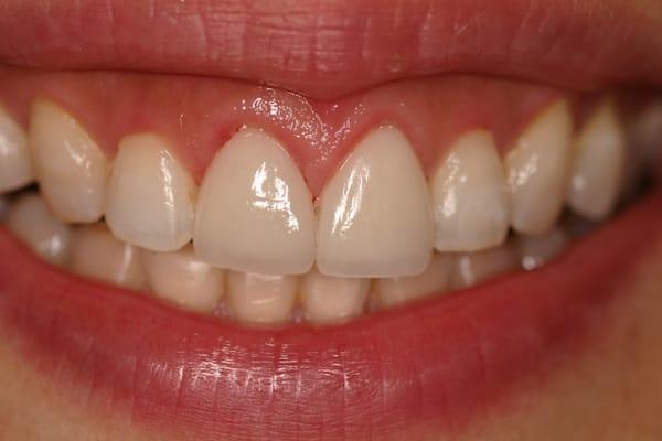 After Corrective Gum Surgery and Veneers