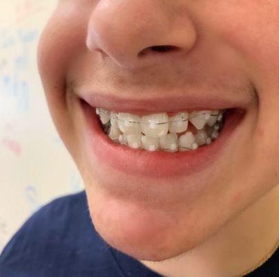 Clear mini braces at Tenbrook orthodontist