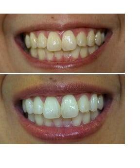 Zoom Teeth Whitening, Los Gatos, CA