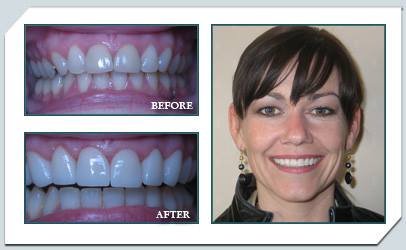 All-porcelain crowns and veneers create a dazzling new look.