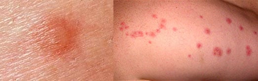 bed bug bites. notice bites are relatively close to one another.