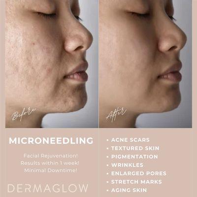 Microneedling