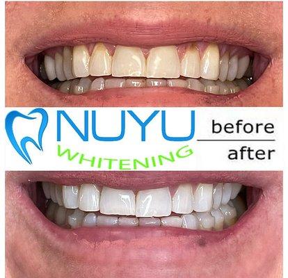 Teeth Whitening Services