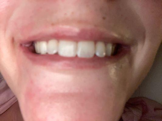 My teeth